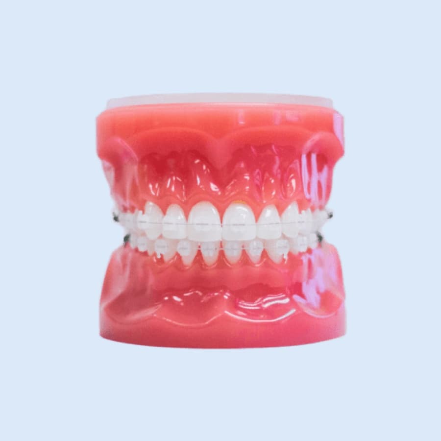 clear braces on plastic model