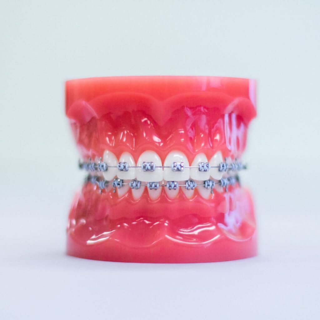 A dental model showing upper and lower teeth fitted with metal braces, used for orthodontic demonstrations, highlights the effectiveness of our orthodontic treatments. - Raleigh Orthodontics